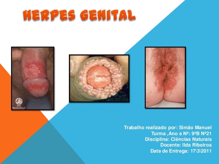 Herpes peniana sintomas fotos 51 Herpes peniana sintomas fotos 100